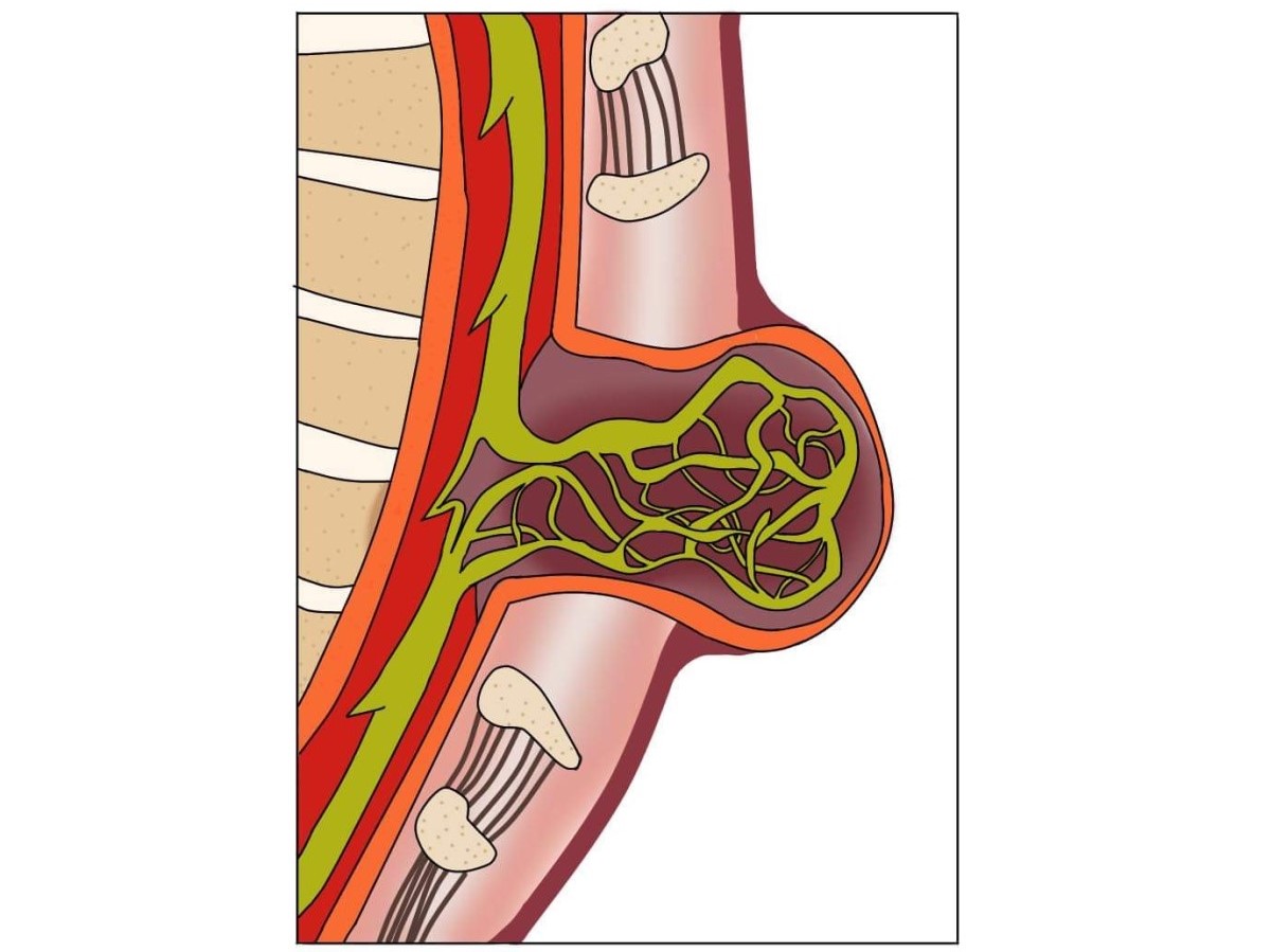 Myelomeningozele, eine offene Spina bifida mit Verdrängung des Rückenmarks und der Spinalnerven.